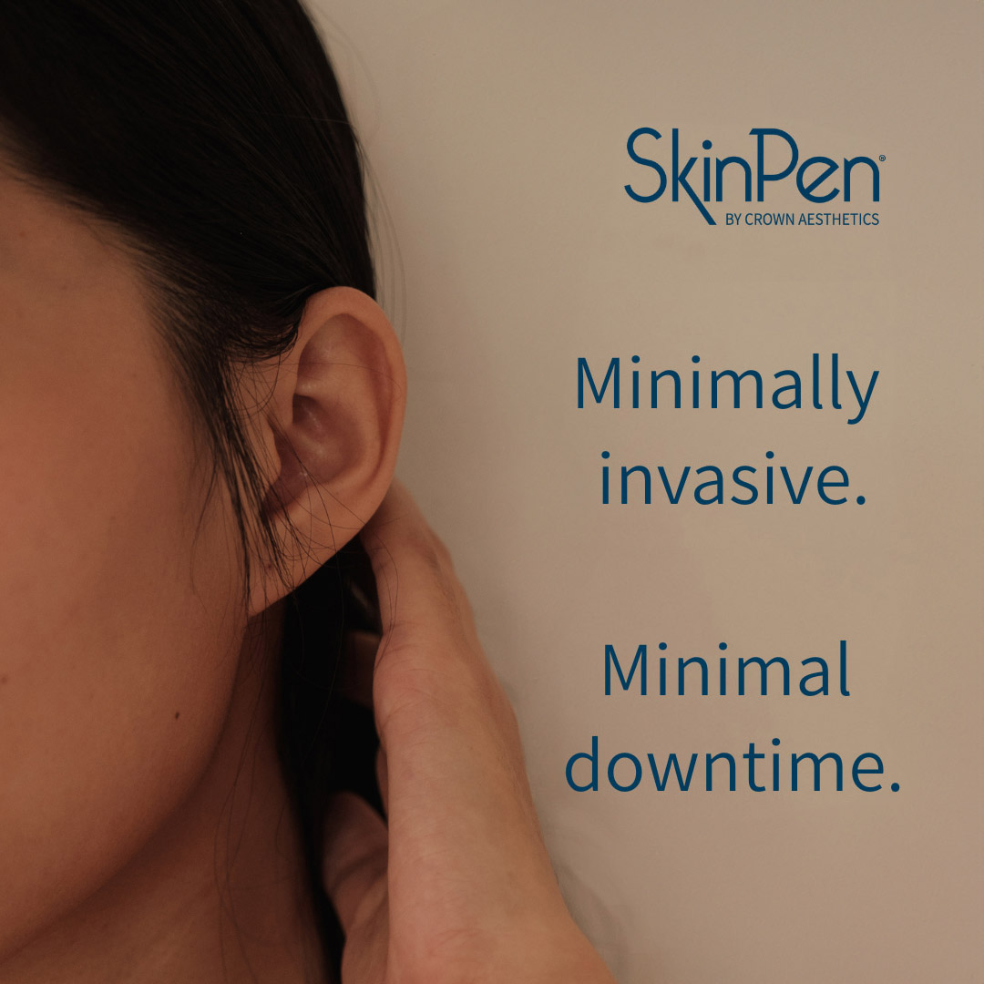 skin-needling---story3sq